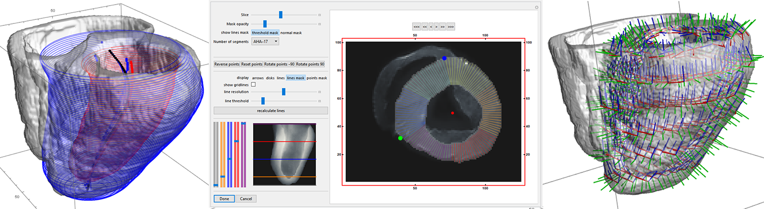 local myocardial coordinate system